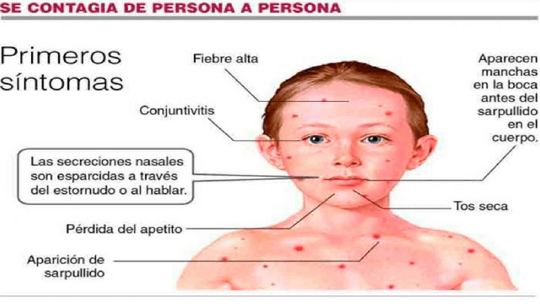 Sarampión 1