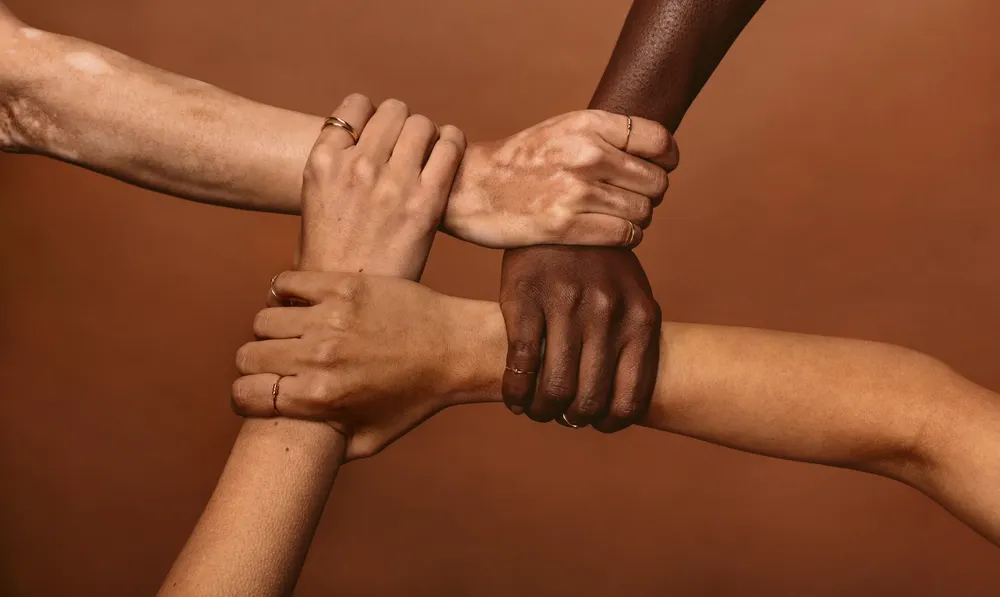 NM_vitiligo_1
